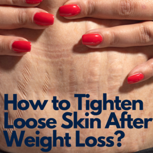 How to Tighten Loose Skin After Weight Loss? | Get Rid of Loose and ...